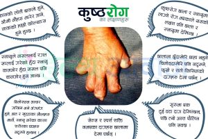 खुल्न डराउँछन् कुष्ठरोगका संक्रमित