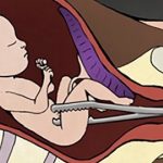 अनिच्छित गर्भ रहेमा गर्भपतन गर्ने सुविधा ?