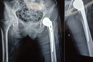 एकसय पाँच वर्षीय बृद्धको सफल जोर्नी प्रत्यारोपण