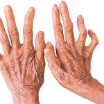 चितवनमा १८ जनामा कुष्ठरोगको सङ्क्रमण